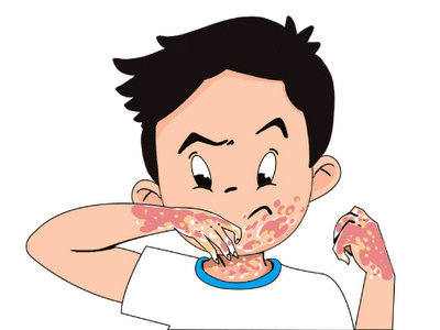 银屑病患者在饮食上要注意些什么