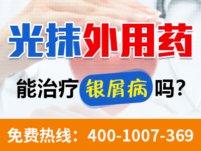 合肥治疗牛皮癣药物